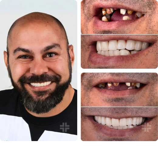 Full-arch implants After