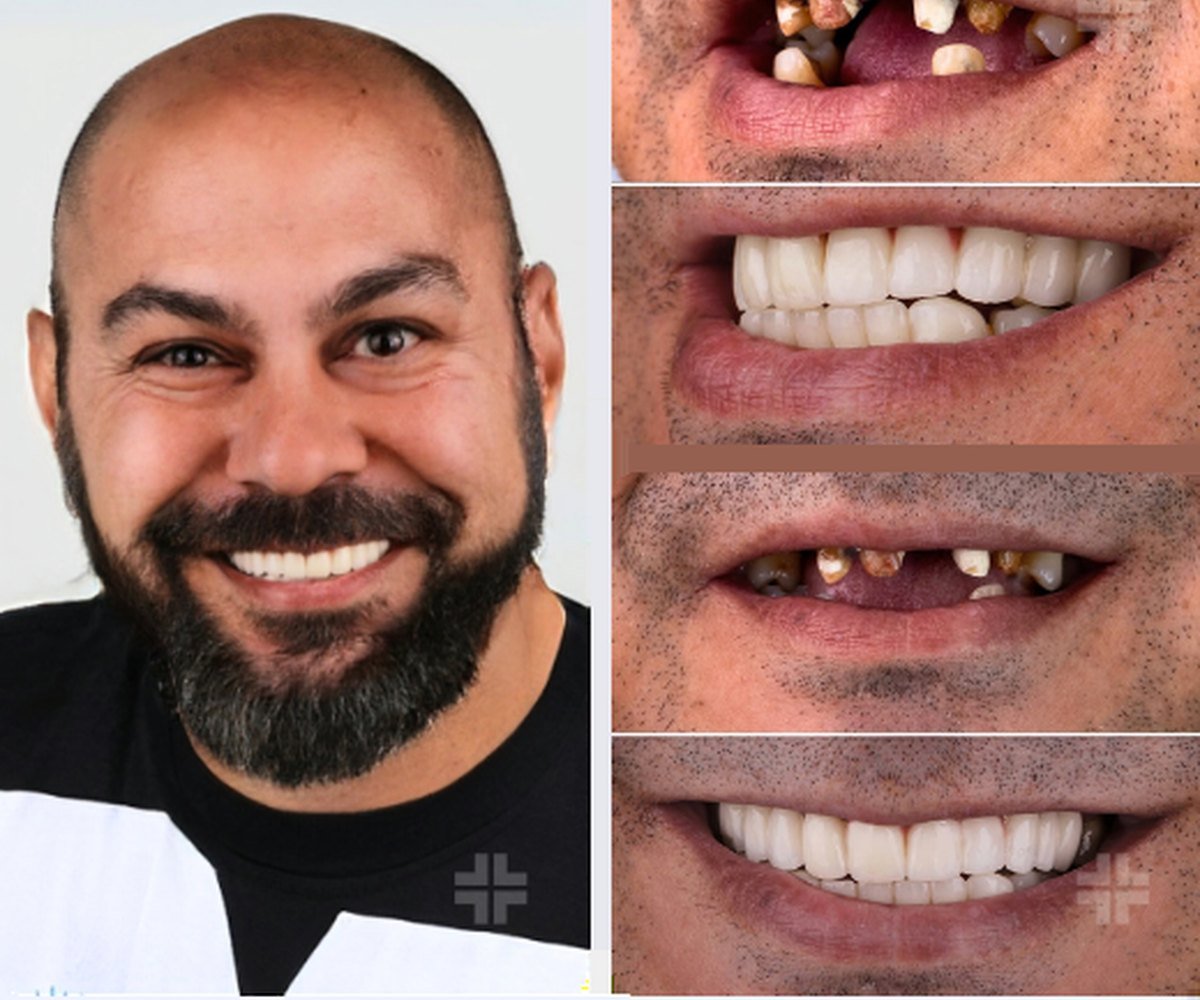 Full-arch implants