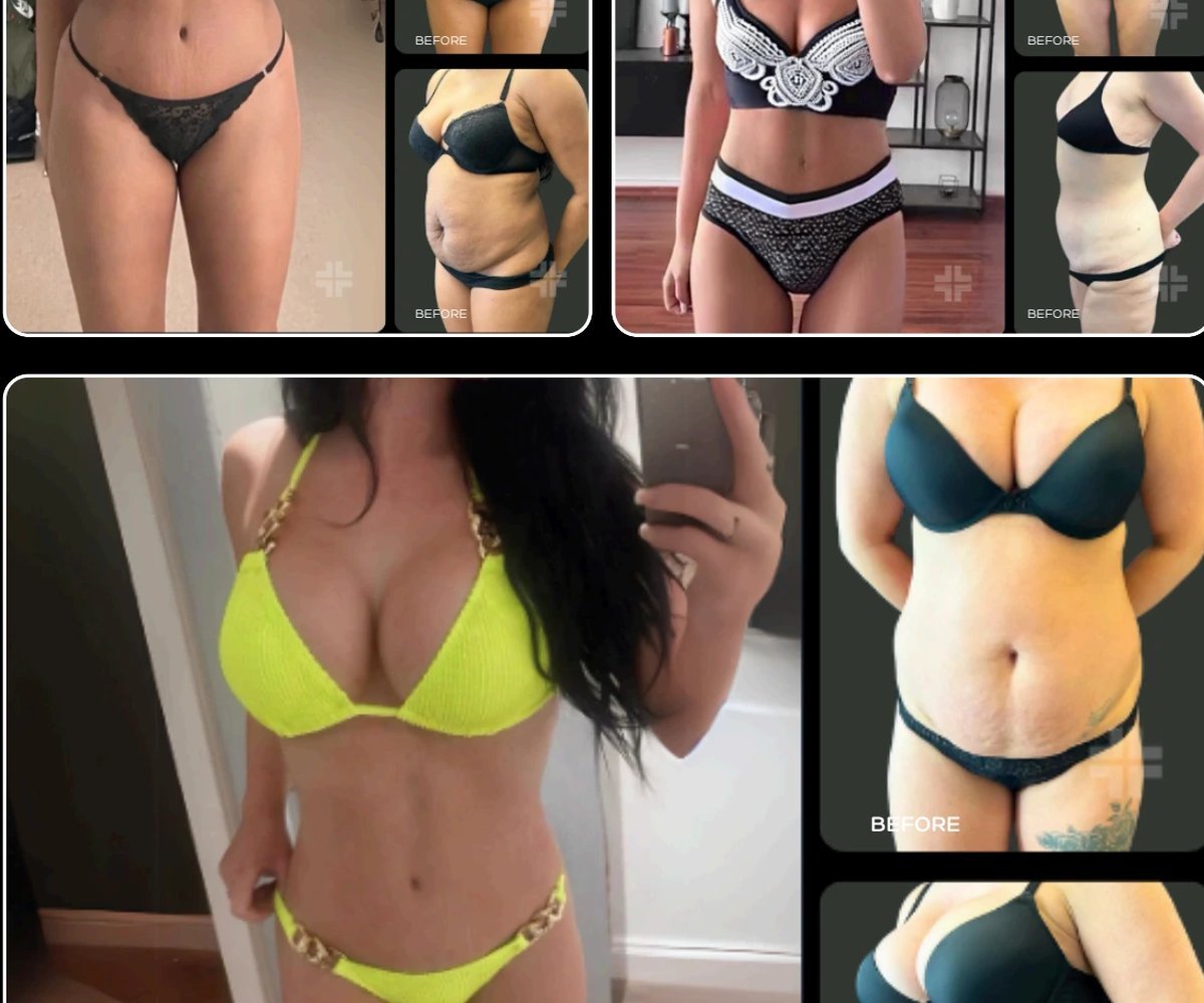 Tummy tuck