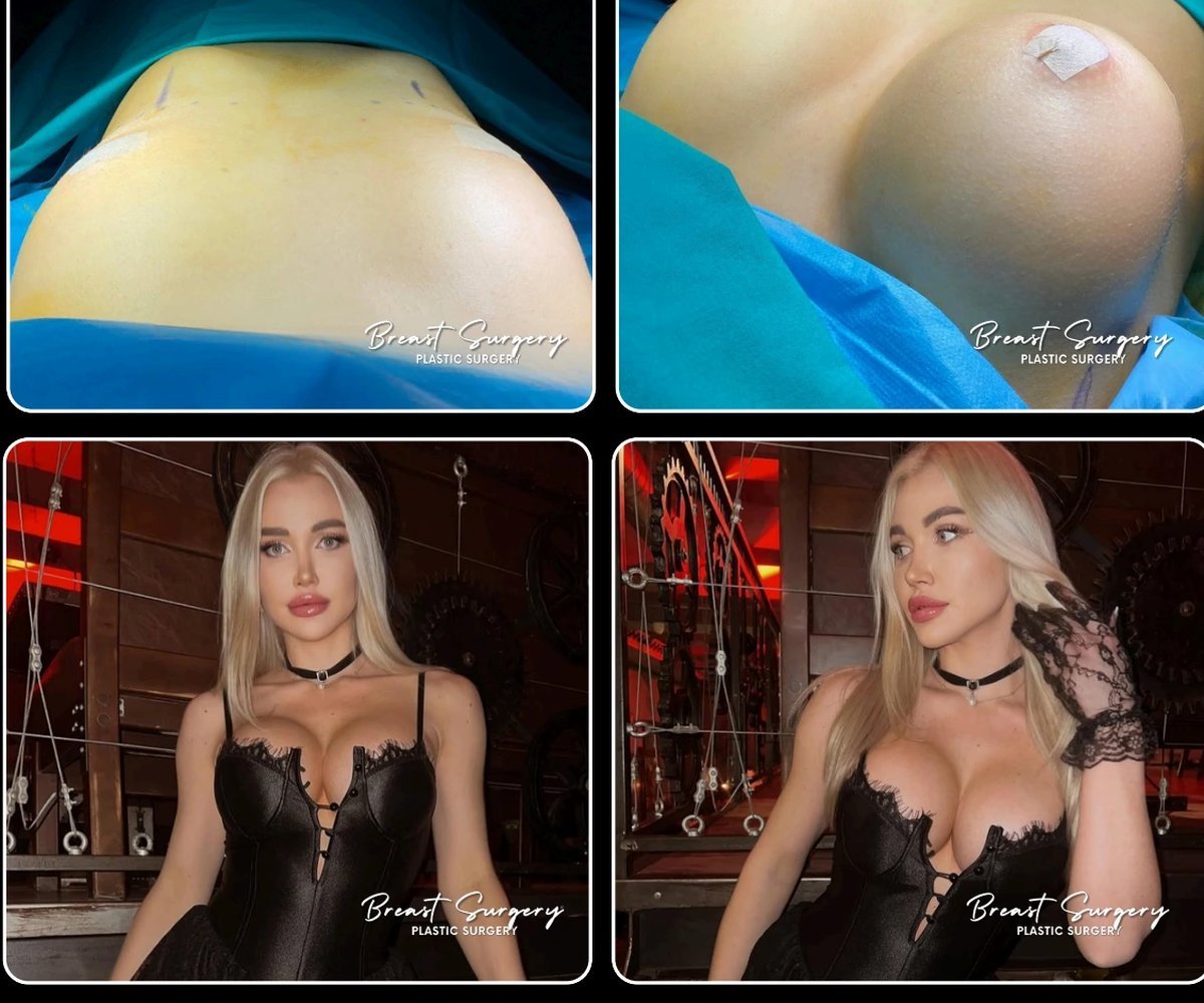 Breast surgery