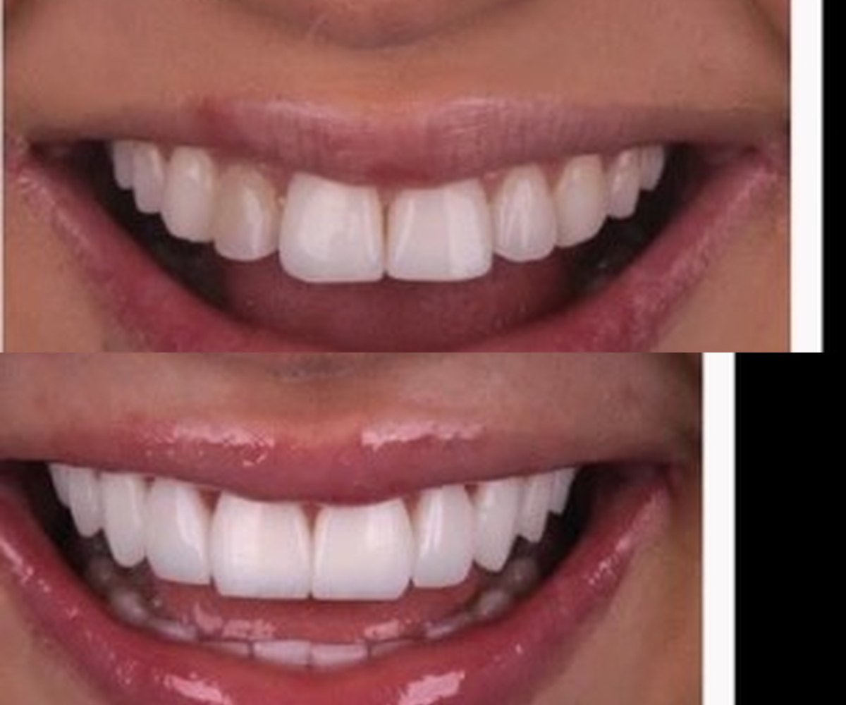 Smile makeover