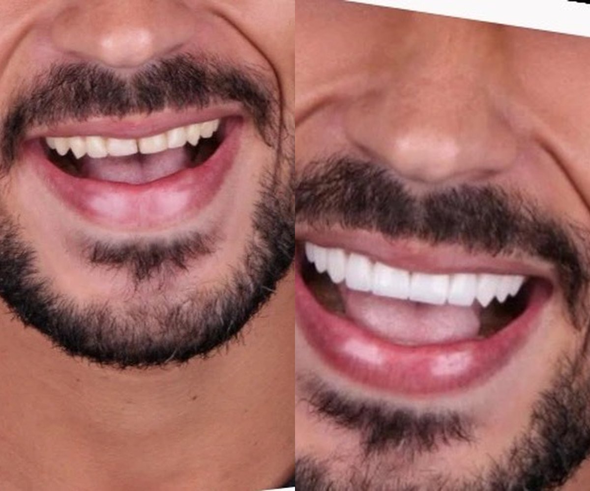 Zirconium crowns