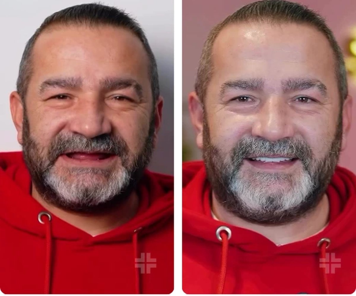 Full-arch implants