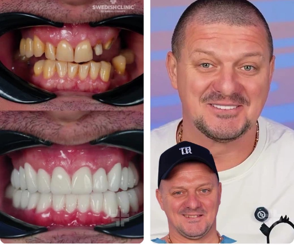 Hollywood Smile