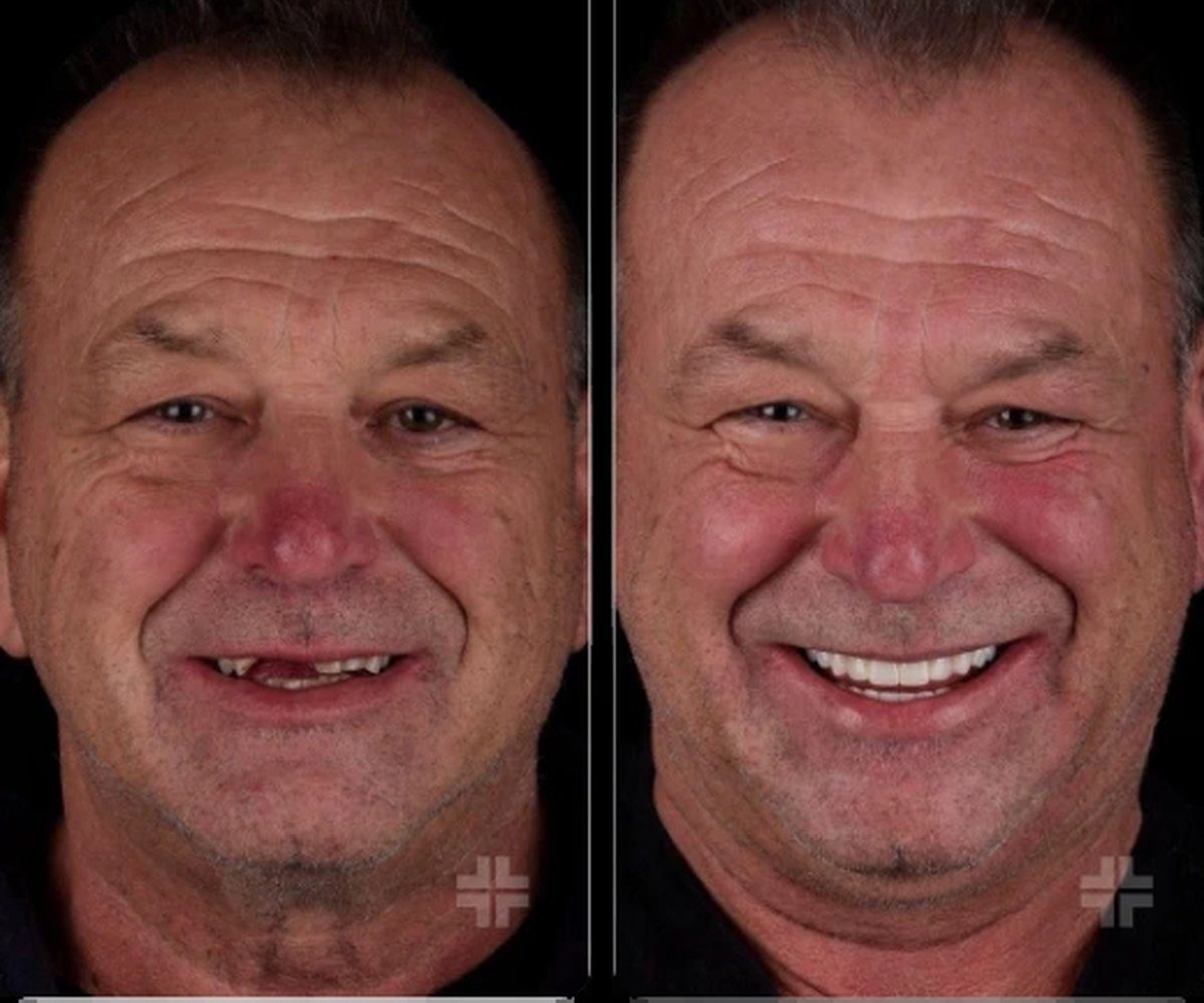 Hollywood Smile
