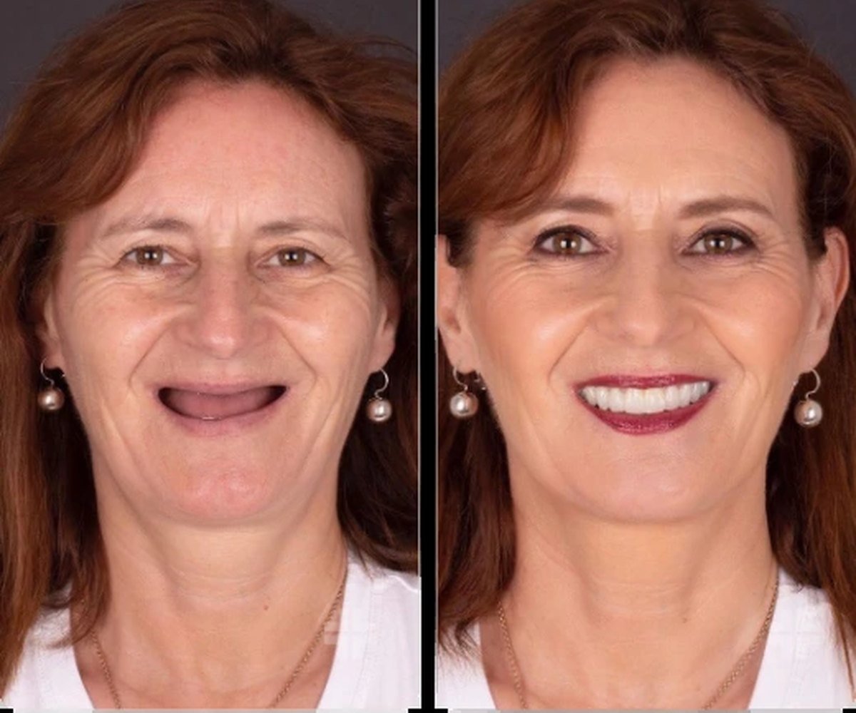 Hollywood Smile