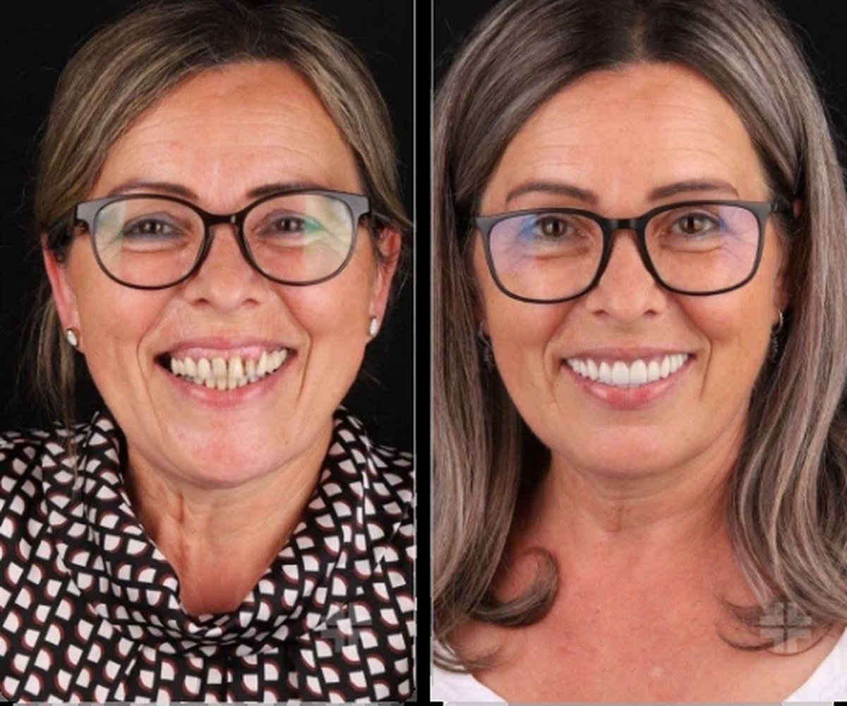 Porcelain veneers