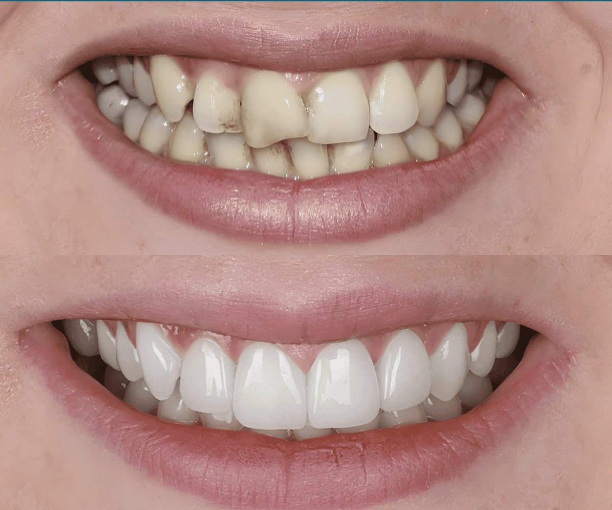 Porcelain veneers