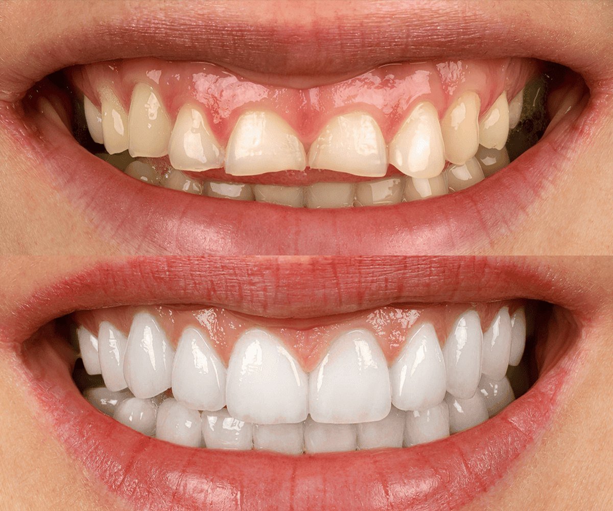 Zirconium crowns