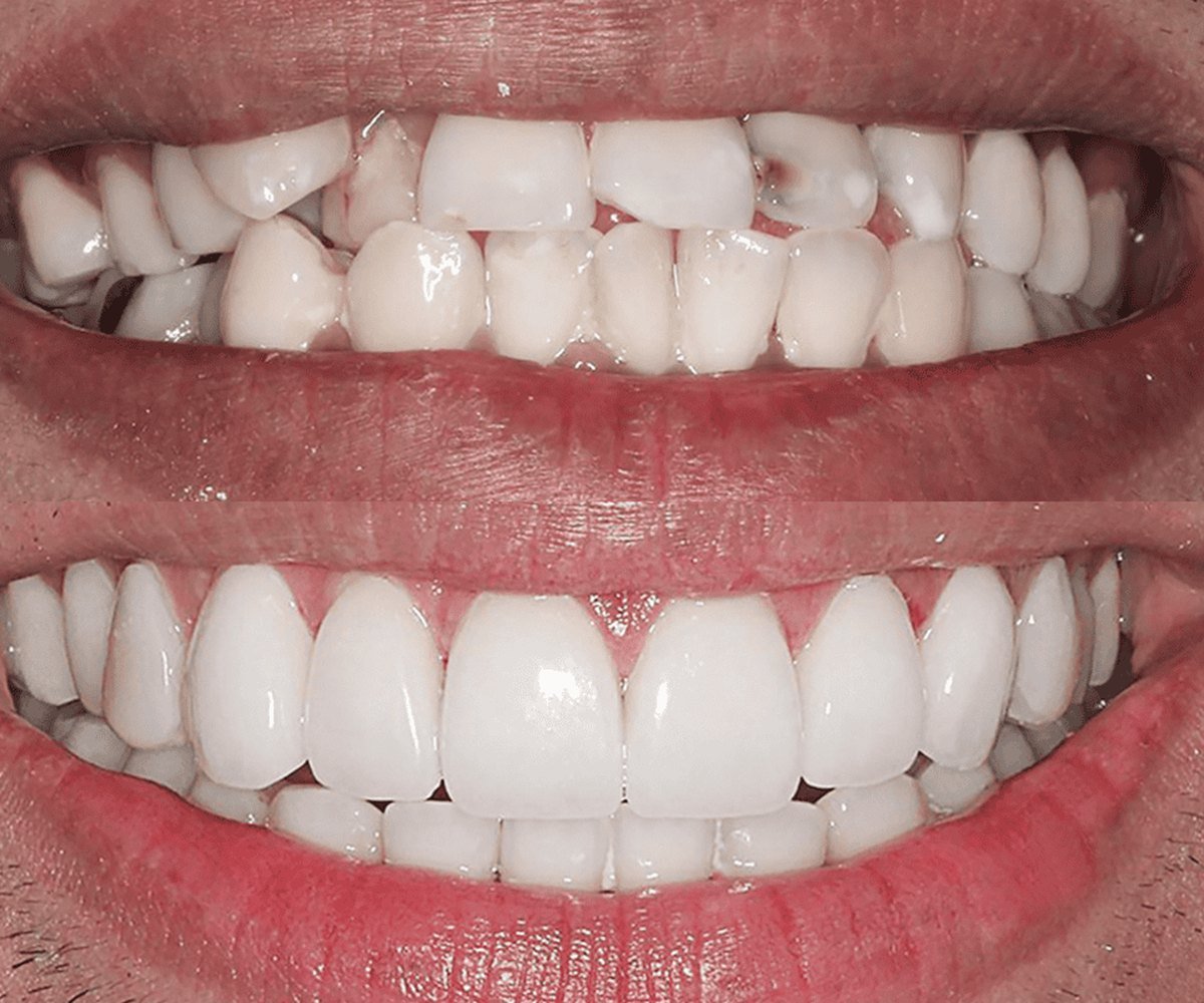 Zirconium crowns