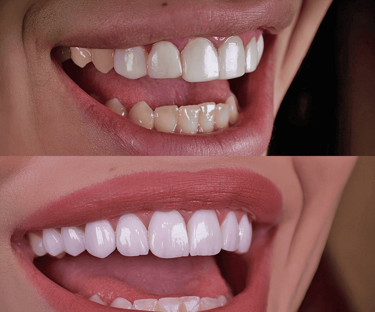 Hollywood Smile
