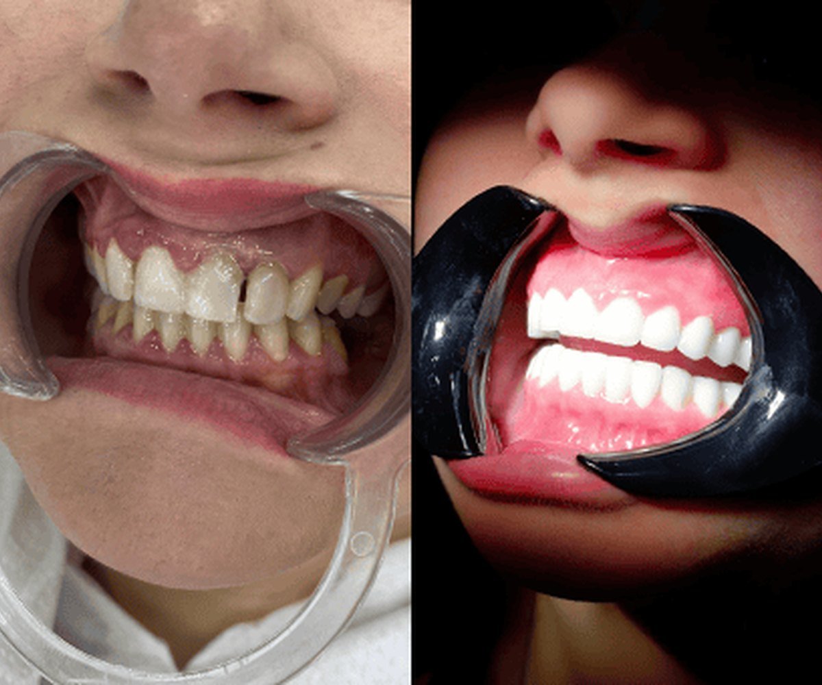 Smile makeover