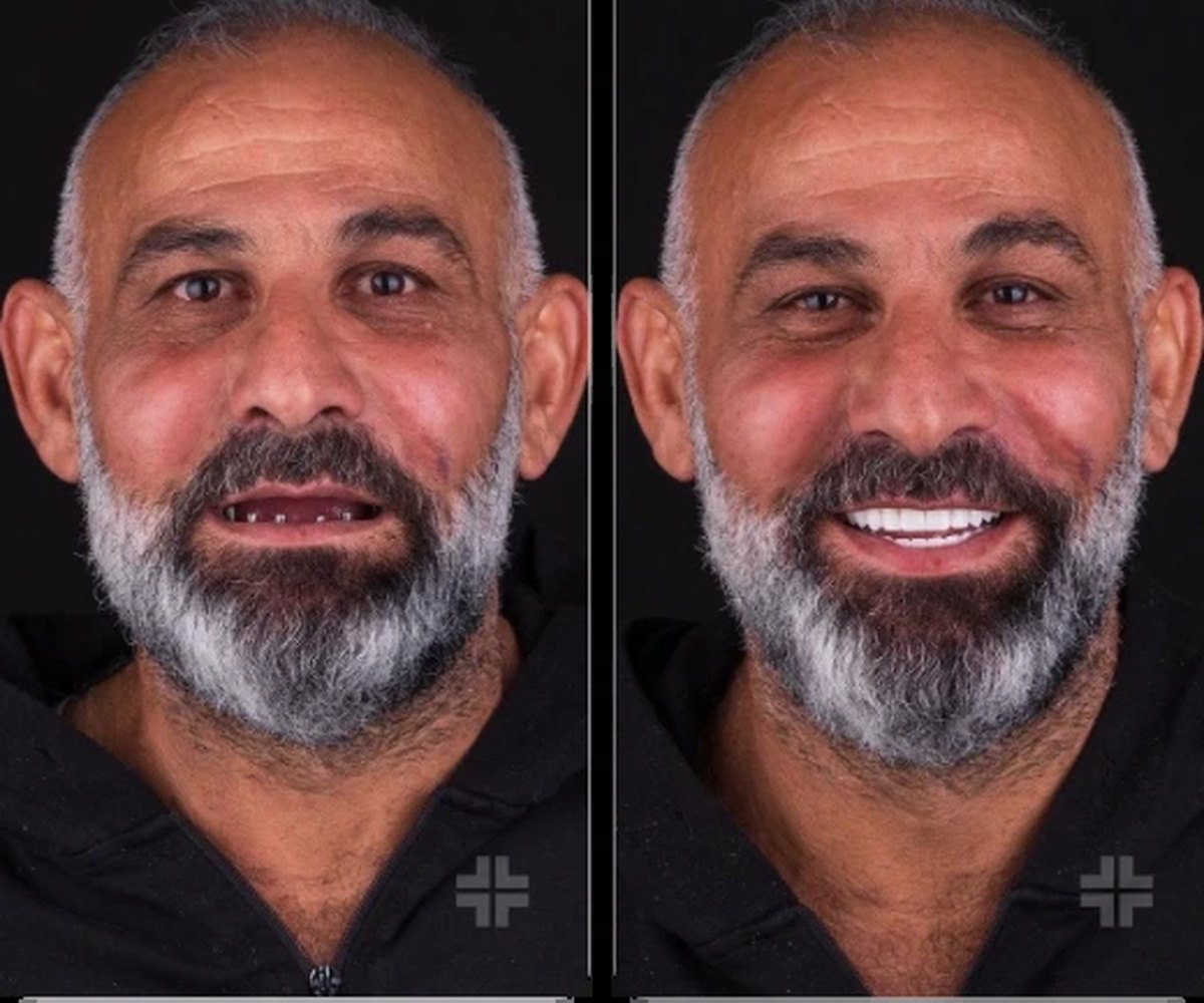 Full-arch implants