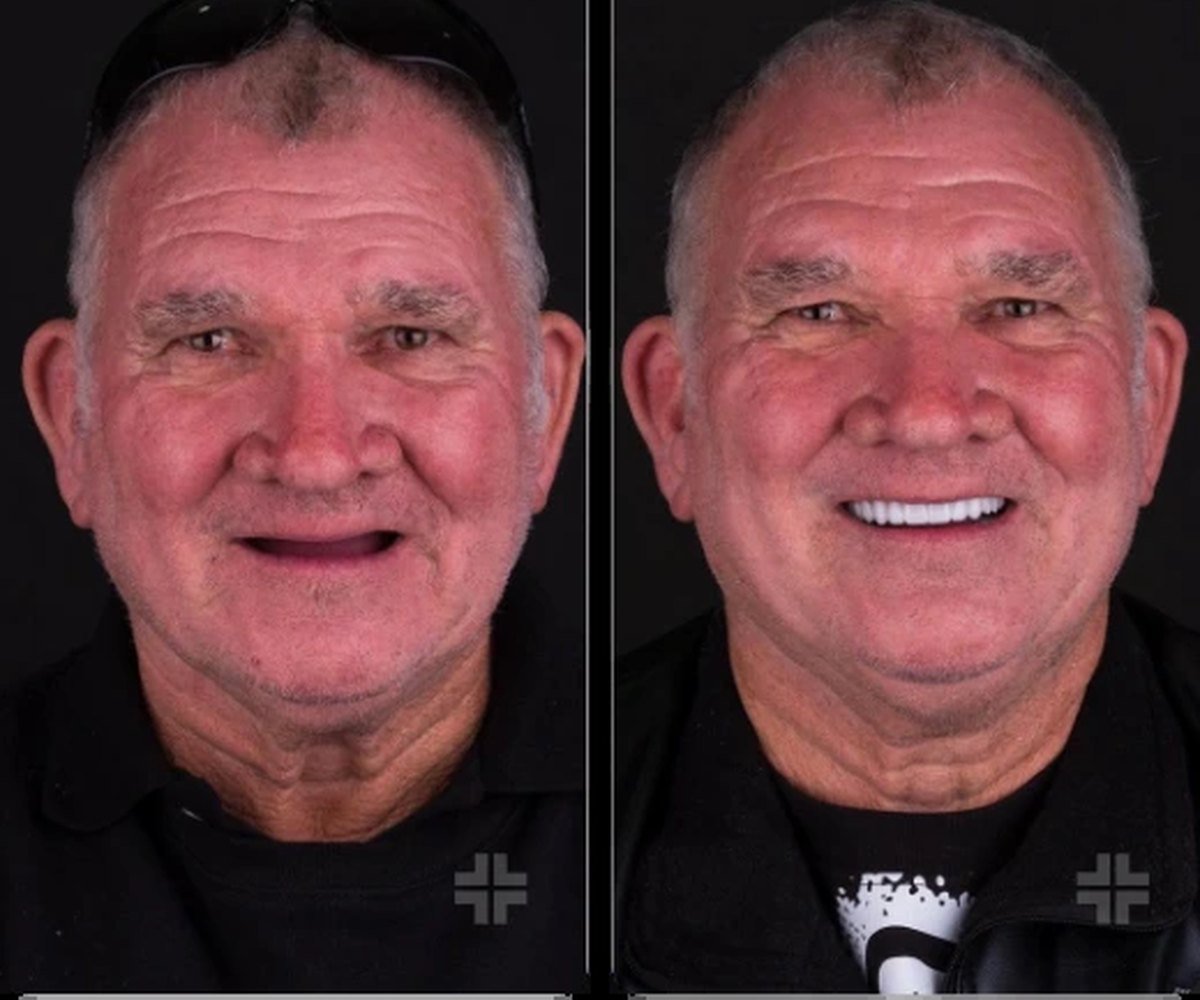 Porcelain veneers