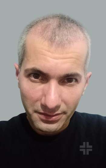 Sapphire FUE Before