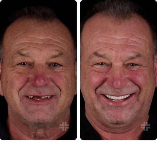 Hollywood Smile After