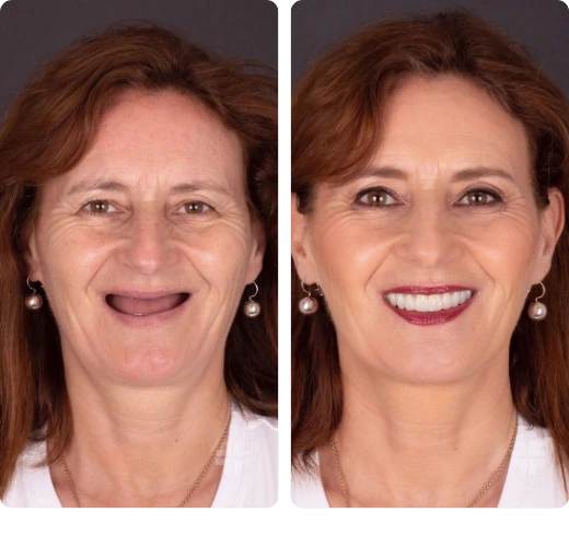 Hollywood Smile Before