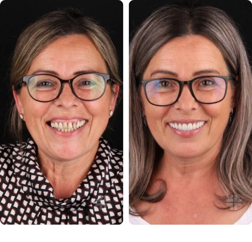 Porcelain veneers Before