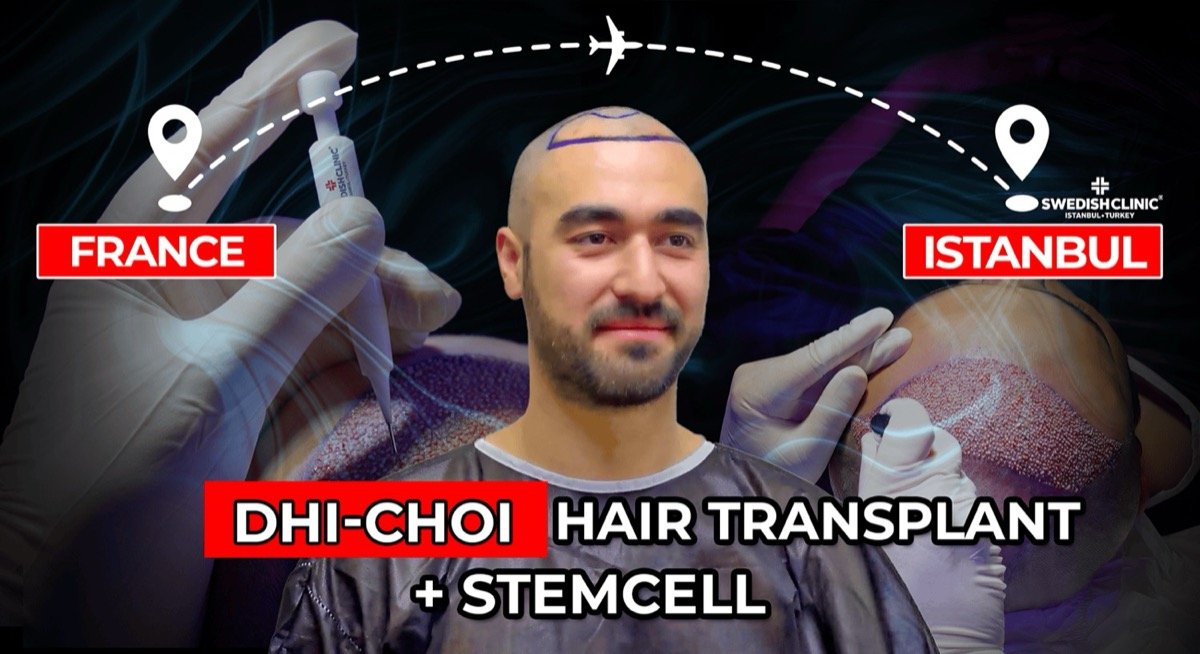 Beard Transplant