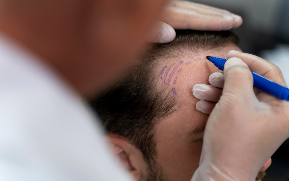Hair Transplant