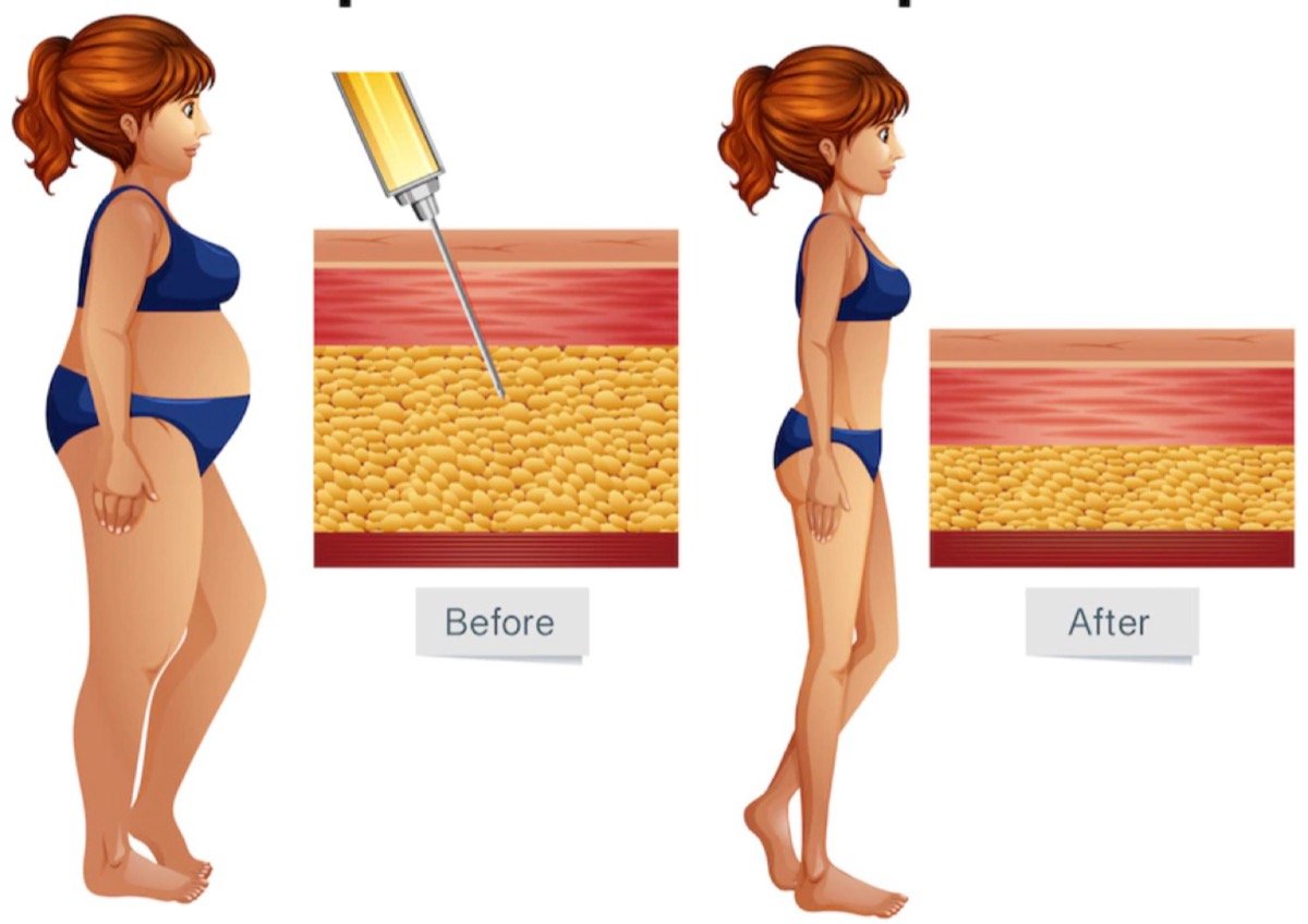 Vaser Liposuction