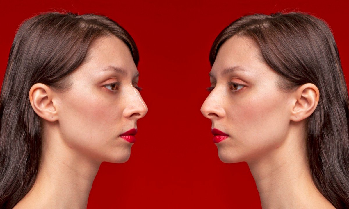 Rhinoplasty