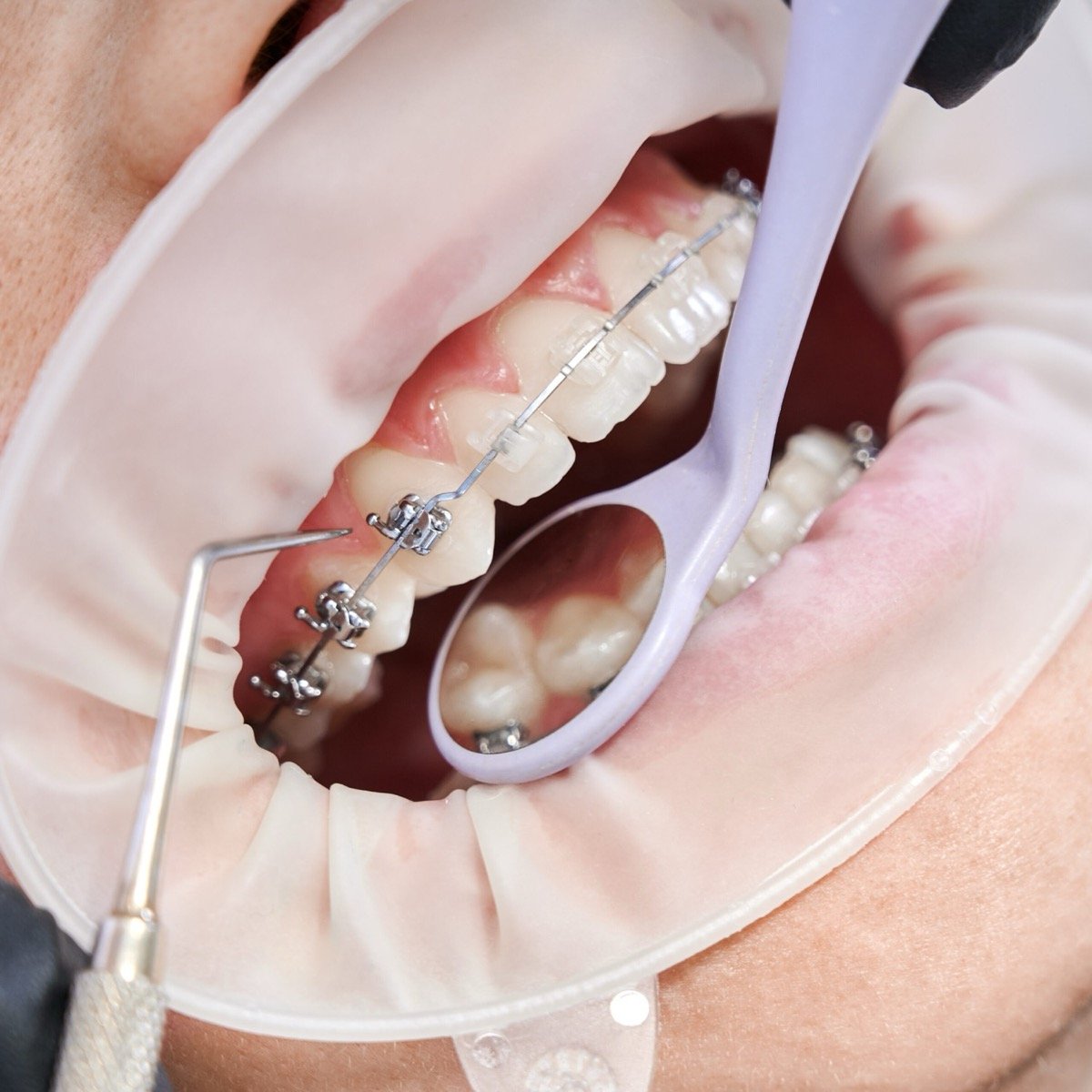 Root Canal Treatment