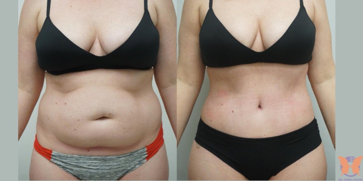 Tummy Tuck
