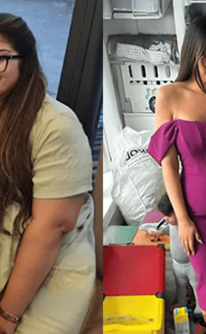 Bariatric surgery Before