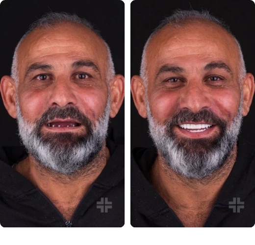 Full-arch implants Before