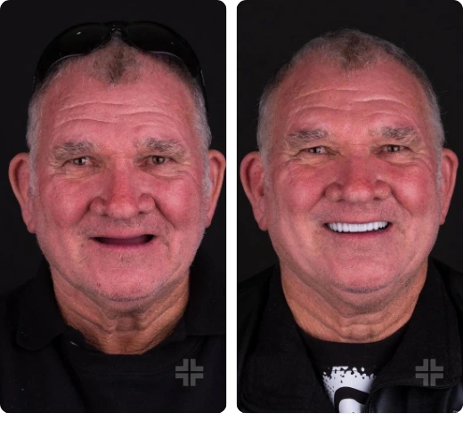 Porcelain veneers After
